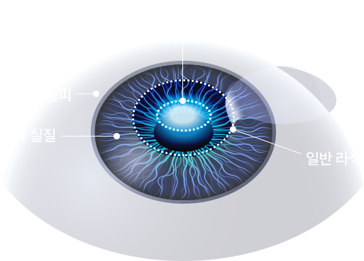 투데이 라섹 , 각막 상피, 각막 실질, 일반 라섹