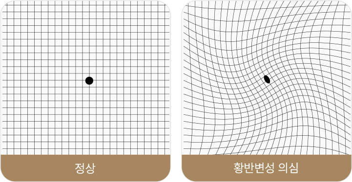 정상 , 황반변성 의심