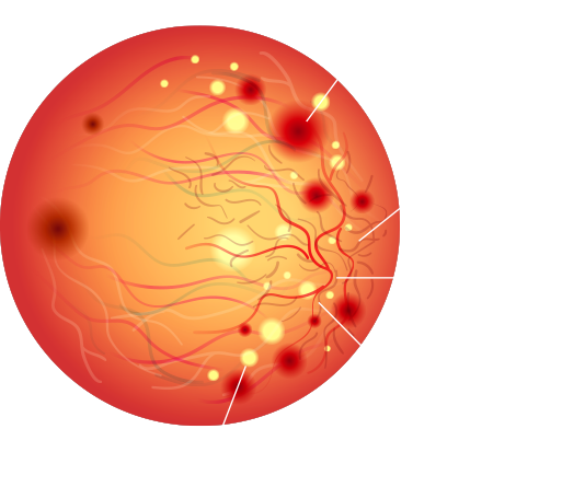 출혈, 신생혈관 증식, 미세동맥류, 면화반, 경성삼출몰