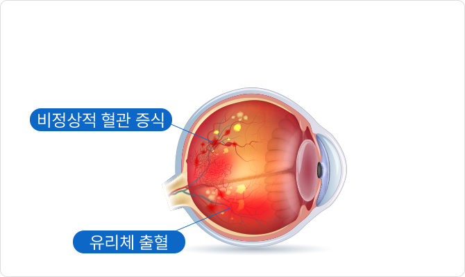 비정상적 혈관 증식,유리체 출혈
