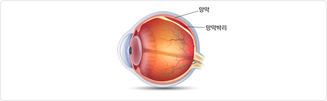 망막 망막박리